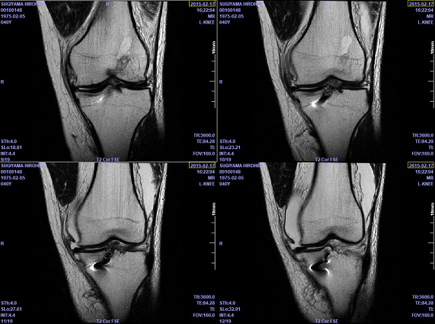 膝のMRI写真