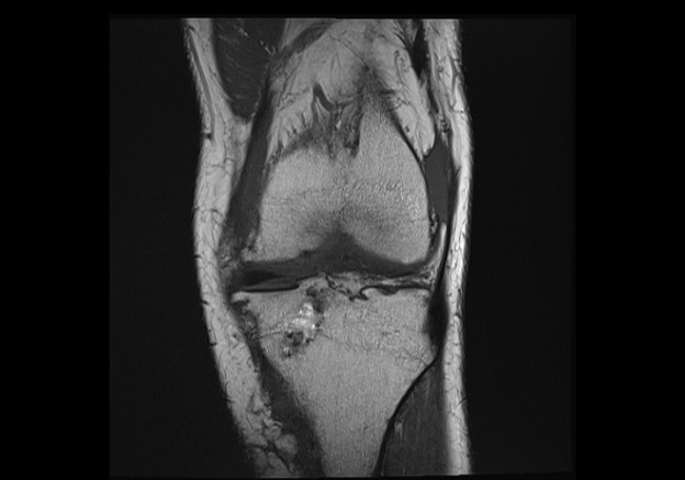 膝内MRI写真